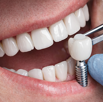Dental Implants